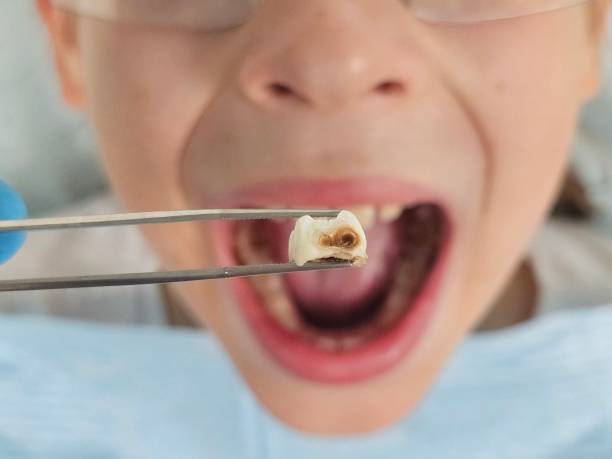 Best Same-Day Emergency Dentist in Hartford City, IN
